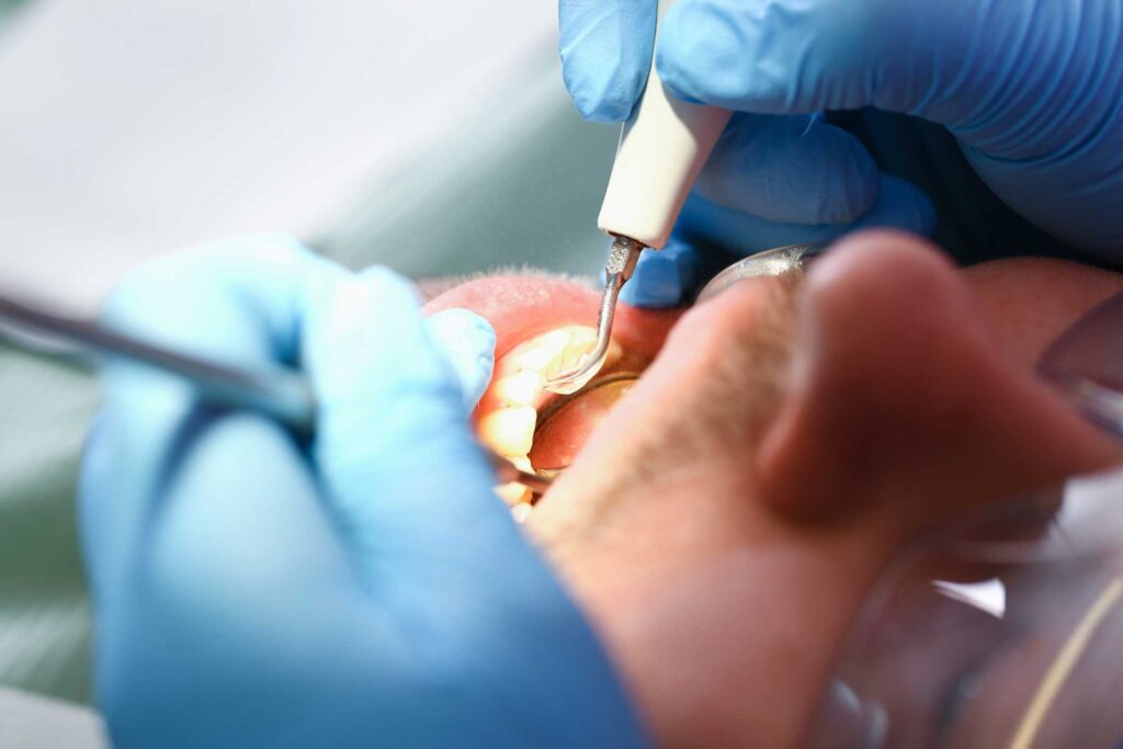 periodoncia en San Vicente del Raspeig, Alicante; tratamiento de encías, enfermedad de las encías, enfermedad periodontal.