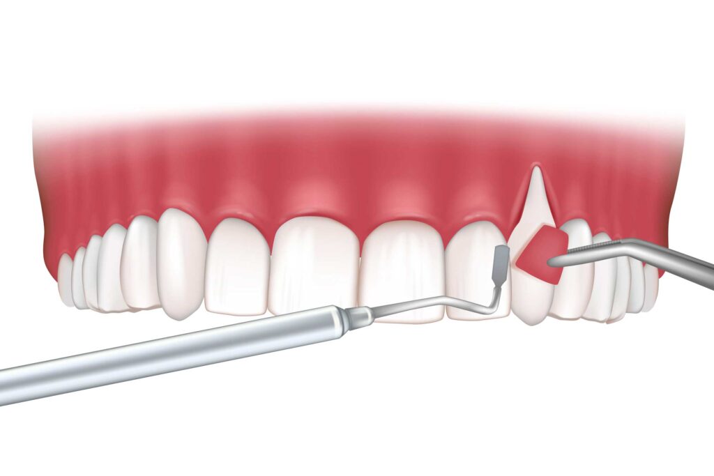 periodoncia en San Vicente del Raspeig, Alicante; tratamiento de encías, enfermedad de las encías, enfermedad periodontal.