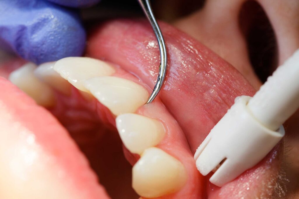 periodoncia en San Vicente del Raspeig, Alicante; tratamiento de encías, enfermedad de las encías, enfermedad periodontal.